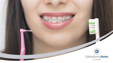 brackets raspallat dental